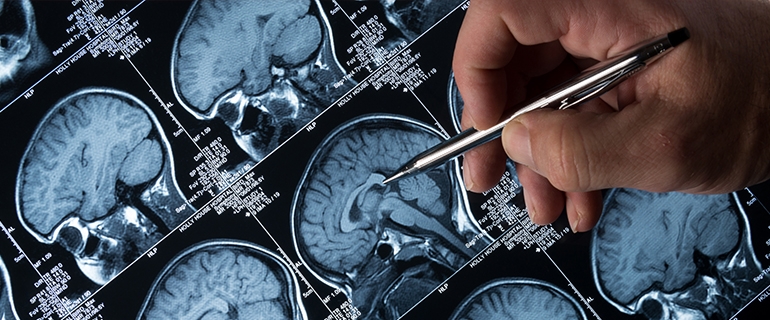 جراحی مغز و اعصاب (نورو سرجری)